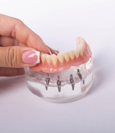 All-on-4 Dental Implants Peoria AZ | Pleasant Dental