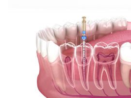 Endodontics & Oral Surgery in Peoria AZ | Pleasant Dental